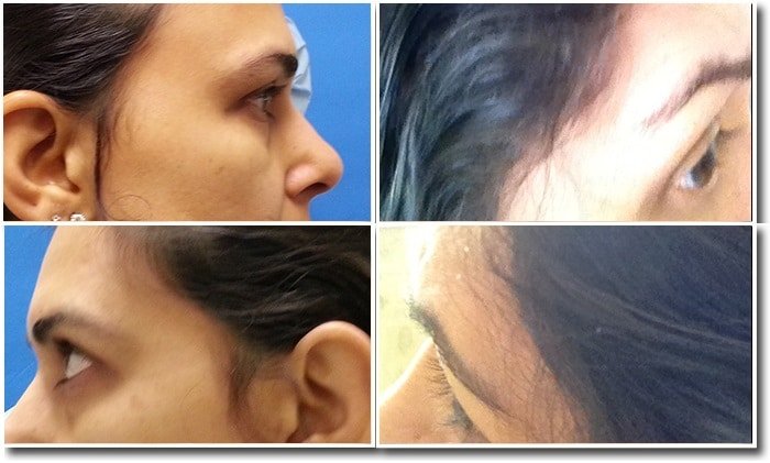 eyebrow hair transplant