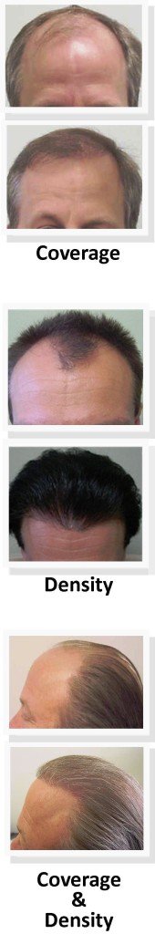 Hair Transplant