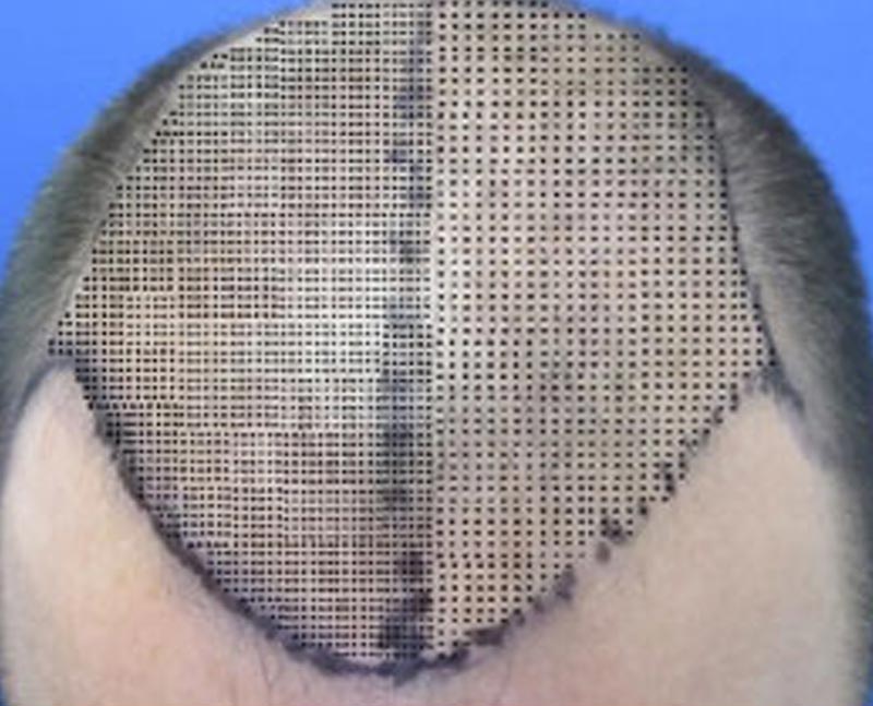 Hair transplant