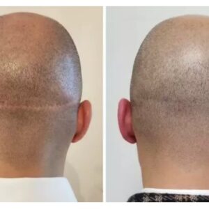 Scalp Micropigmentation San Diego