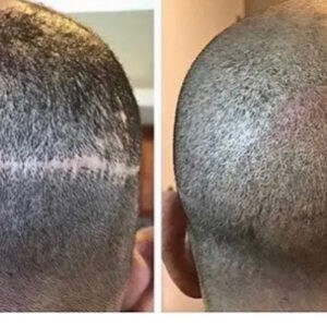 Scalp Micropigmentation scar revision